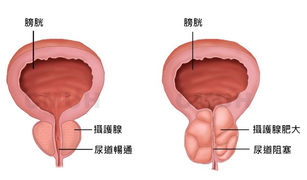 攝護腺